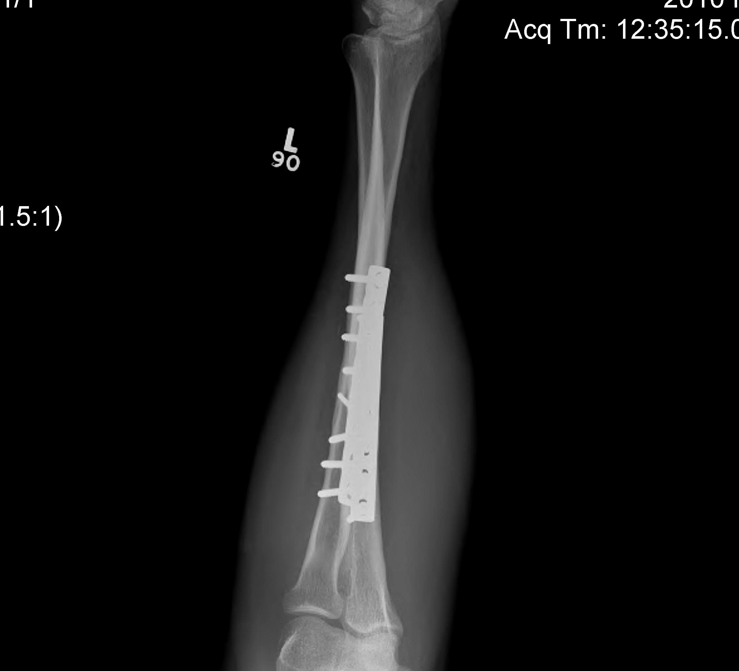 Forearm Fractures Plate Lateral